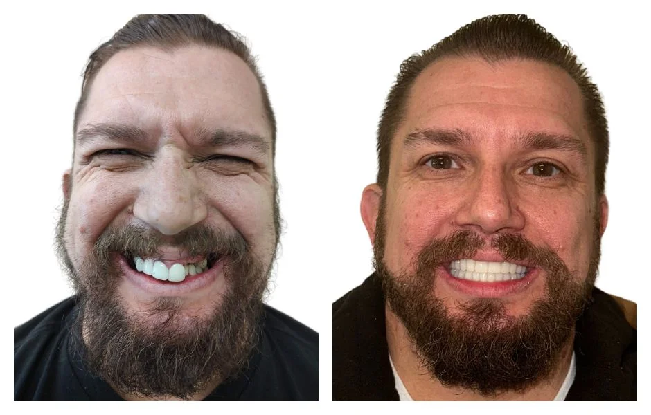 all on six dental implants folsom