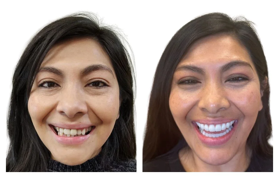 all on six dental implants near me